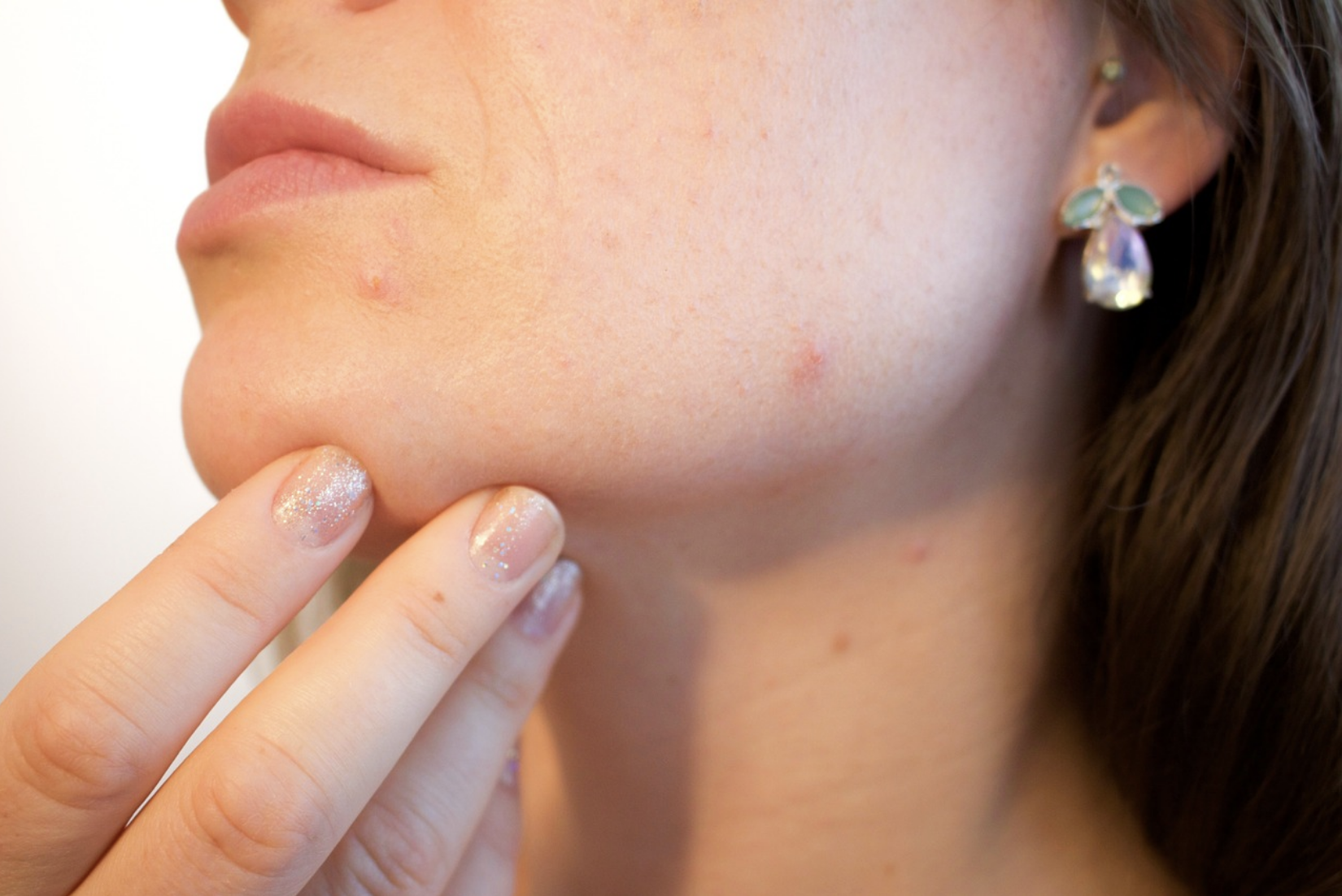 Did You Know That These Factors Can Cause Acne Scars?